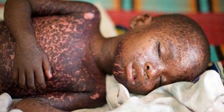 Santé : Présence de la rougeole à Lubumbashi