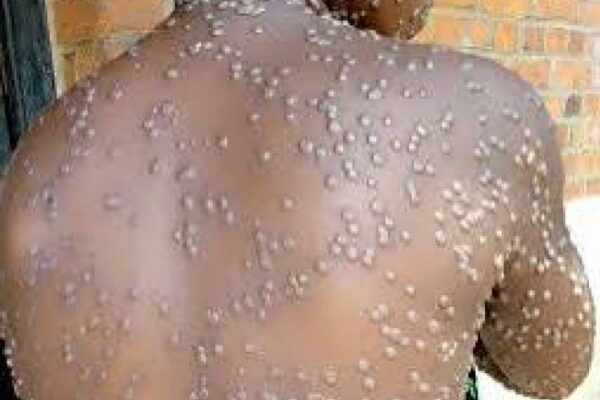 Ituri : deux cas de Mpox confirmés dans la zone de santé de Rwampara mpox